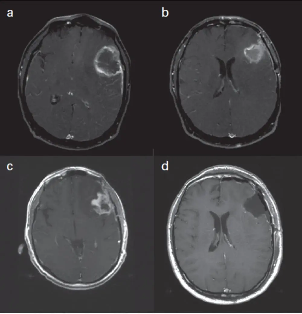 Updated Response Assessment Criteria for High-Grade Gliomas: Response Assessment in Neuro-Oncology Working Group. J Clin Oncol. 2010 Apr 10;28(11):1963-72, p.1965
