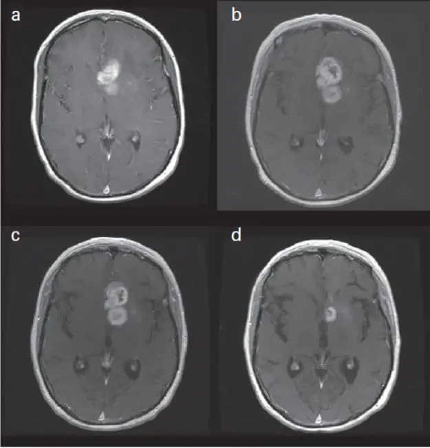 Updated Response Assessment Criteria for High-Grade Gliomas: Response Assessment in Neuro-Oncology Working Group. J Clin Oncol. 2010 Apr 10;28(11):1963-72, p.1965