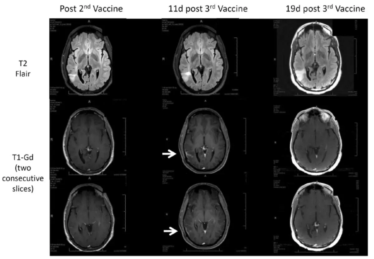 Immunotherapy Response Assessment in Neuro-Oncology (iRANO): A Report of the RANO Working Group. Lancet Oncol. 205 Nov;16(15):e534-e542