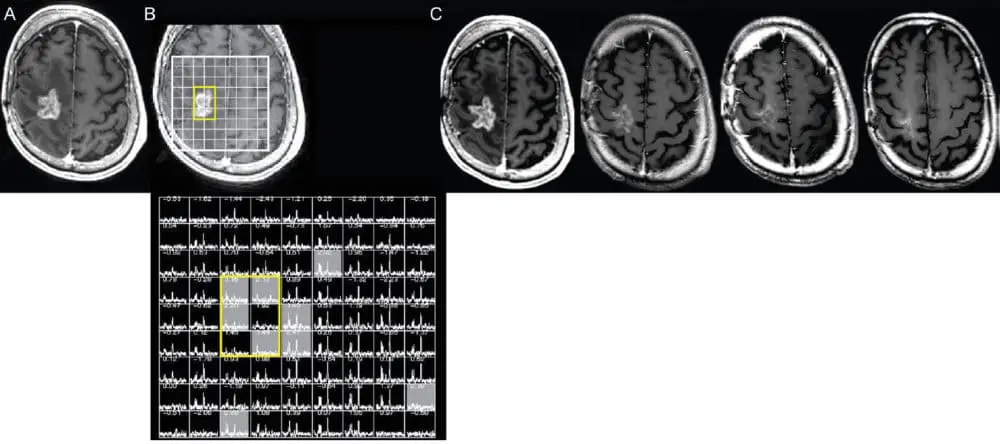 Pseudoprogression versus true progression in glioblastoma: what neurosurgeons need to know. J Neurosurg. 2023 September 01; 139(3): 748-759, p. 752