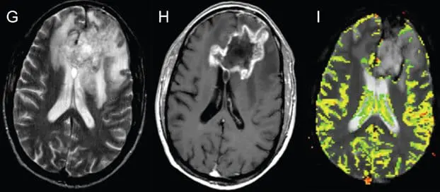 Pseudoprogression versus true progression in glioblastoma: what neurosurgeons need to know. J Neurosurg. 2023 September 01; 139(3): 748-759, p. 751