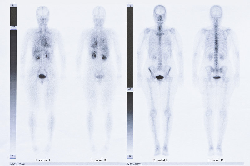 A bone scan (skeletal scintigraphy) is a special type of nuclear medicine procedure that uses small amounts of radioactive material to diagnose and assess the severity of a variety of bone diseases and conditions, including fractures, infection, and cancer