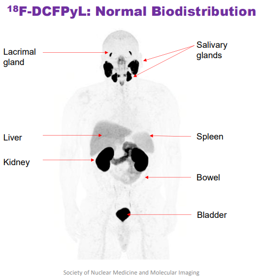 Factors like normal biodistribution should be considered when performing PSMA PET/CT imaging or any other nuclear medicine study. Reader selection and appropriate training for the particular protocol being used is key for trial success.