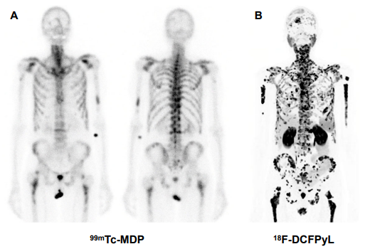These images were taken of the same patient, one day apart. The images are promising for detecting osseous lesions. Mild uptake is shown on the Tc-MDP bone scan study on the left-hand side compared to the PSMA PET/CT imaging agent on the right hand side.