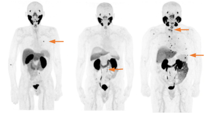 In the example images shown here, all three patient images are positive for PSMA avid regions of interest, indicated by the arrows.