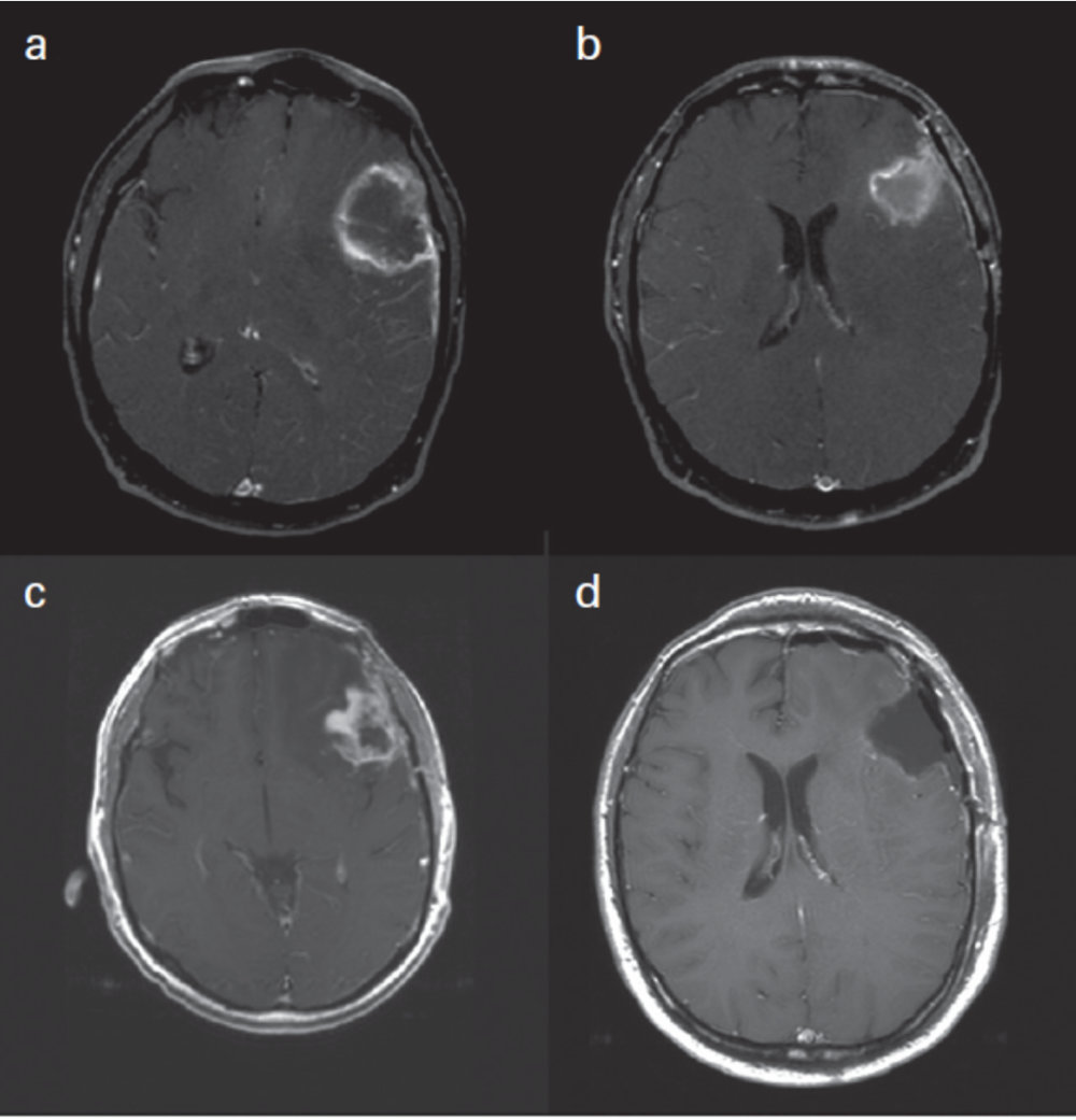 Updated Response Assessment Criteria for High-Grade Gliomas: Response Assessment in Neuro-Oncology Working Group. J Clin Oncol. 2010 Apr 10;28(11):1963-72, p.1965